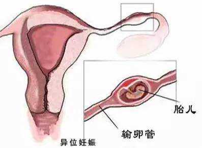 广州代怀费用先兆临产的表现（分娩征兆）